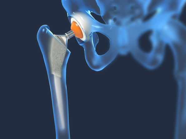AOTCO Metal Finishing Titanium Medical Devices & Medical Implants. ISO 13485:2016